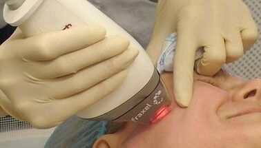 Hogyan történik a frakcionált bőrfiatalítás