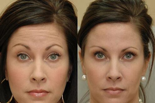 A botulinum toxin injekciók az arc bármely területén alkalmazhatók