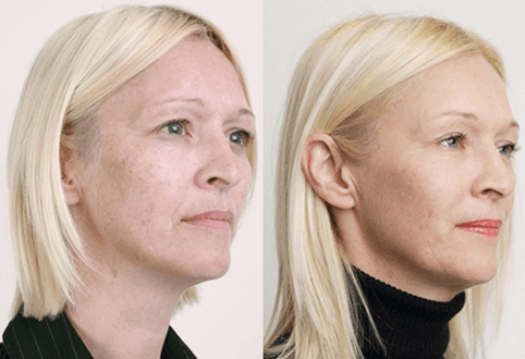 Közepes peeling gyümölcssavakkal