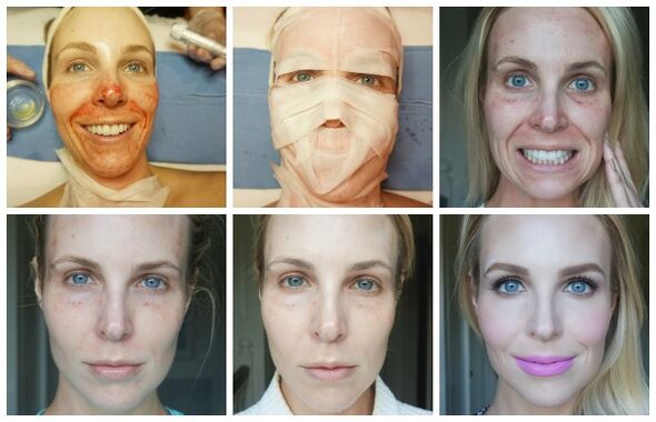 Az arcbőr gyógyulásának szakaszai sikeres plazma lifting után