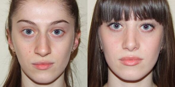 Lány plazma arcbőrfiatalítás előtt és után