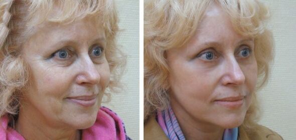 Nő plazma arcbőrfiatalítás előtt és után